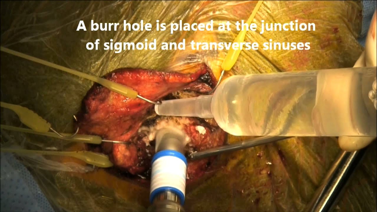 Retrosigmoid approach for resection of cerebellopontine angle meningioma