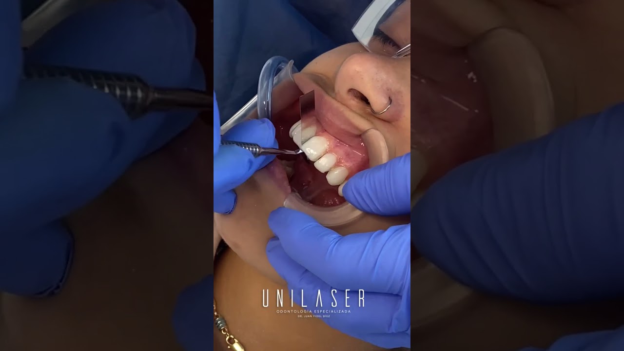 As&iacute; realizamos tu dise&ntilde;o de sonrisa con carillas en resina