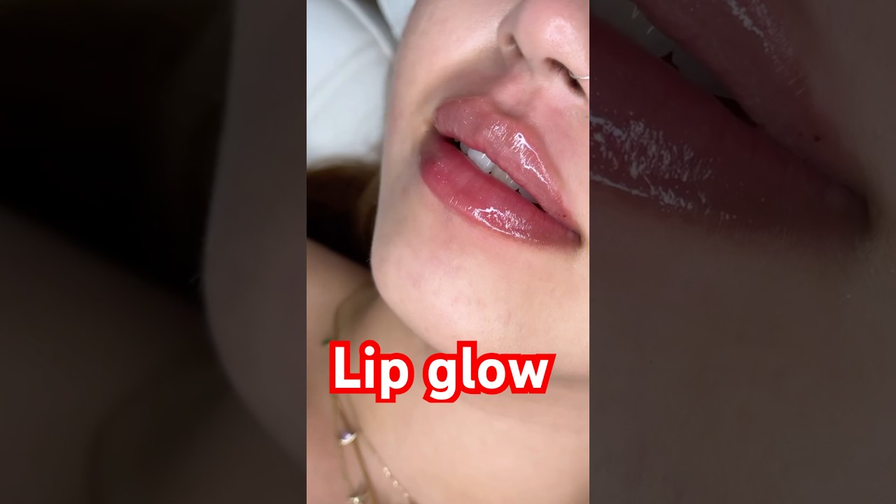 Lip Filler Transformation | Natural Russian Technique | Before & After 