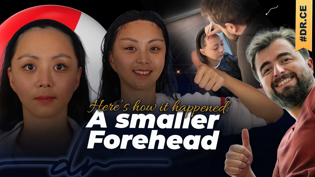 My Real Experience After Forehead Reduction in Istanbul
