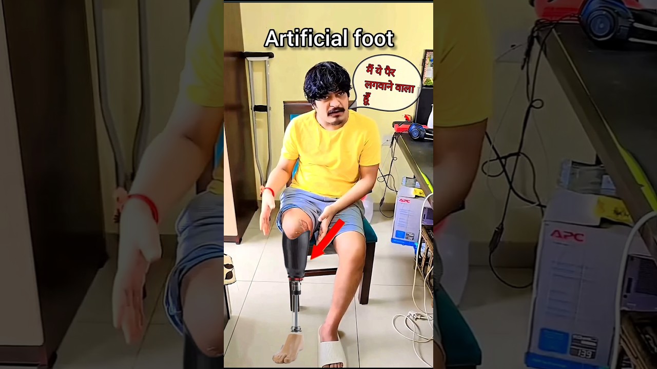 gyan gaming accident 👺 ||artificial foot for leg prosthesis