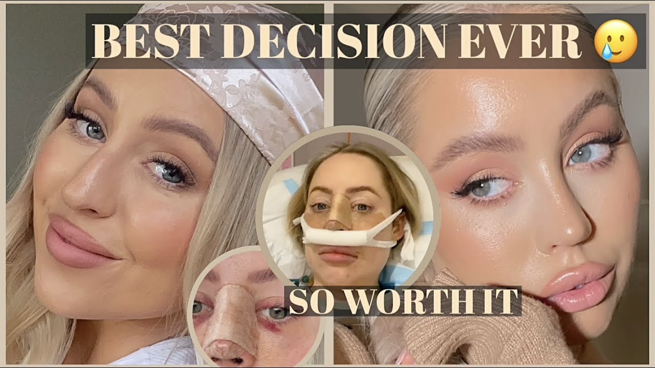 Видеоблог о ринопластике. Моё полное восстановление после ринопластики + результаты *лучший хирур...