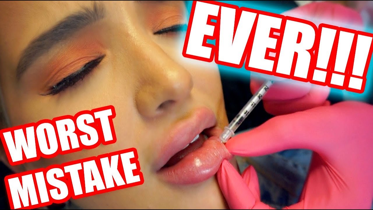 WHY I GOT MY LIP FILLER DISSOLVED