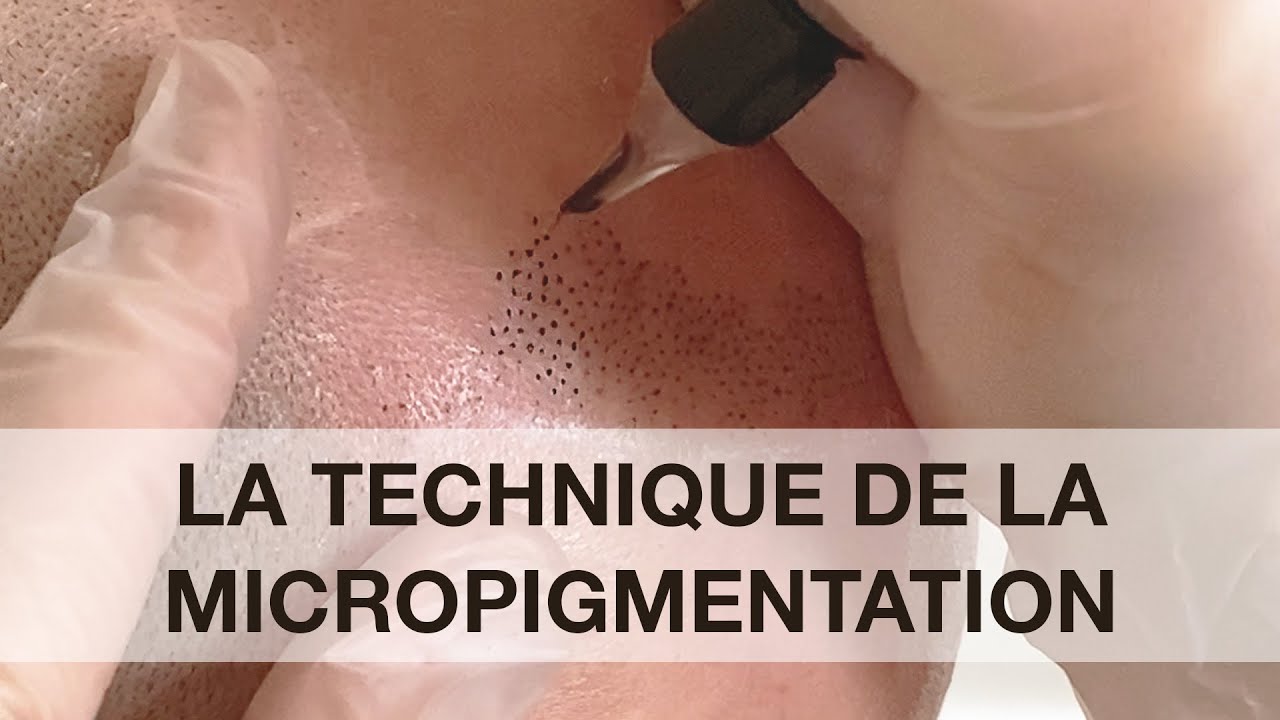 La dermopigmentation capillaire ou Tricopigmentation