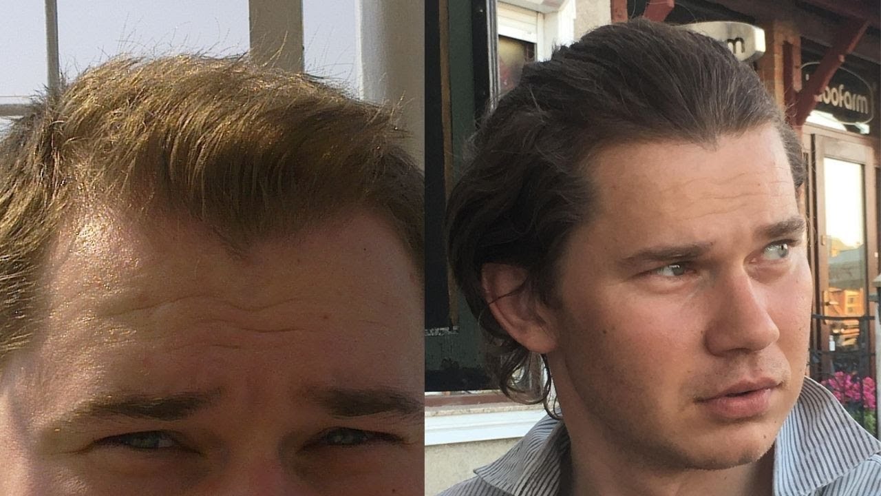 White Bulbs On Hair That Are Falling Out | Is It the Hair Root?