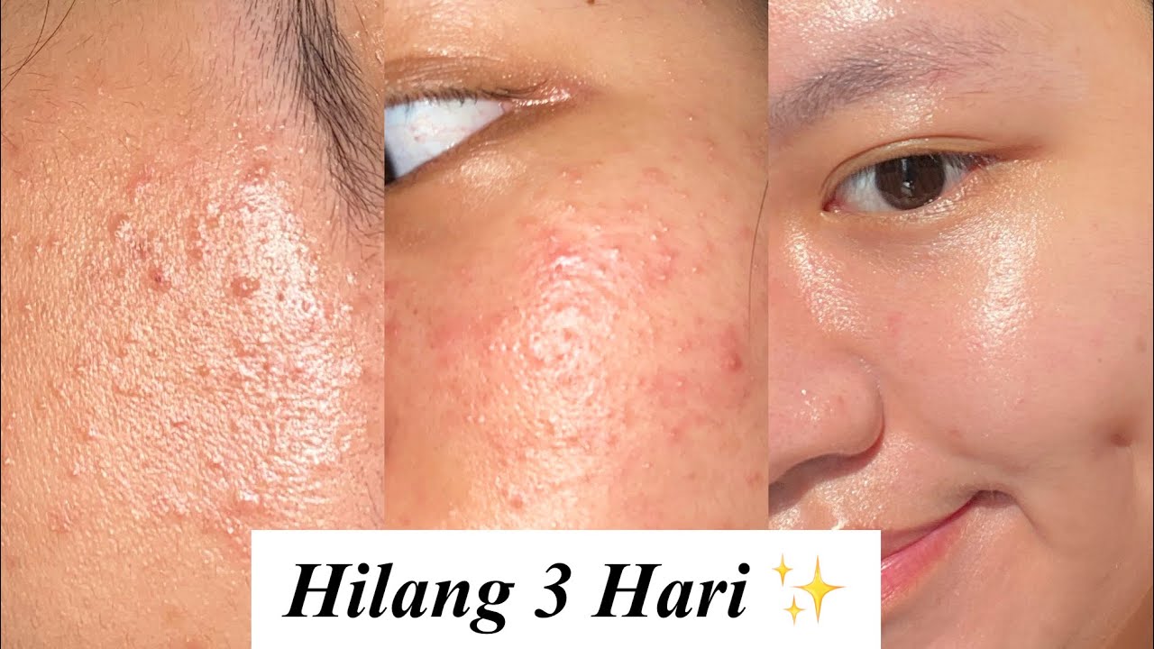 My Skincare Routine utk Bruntusan