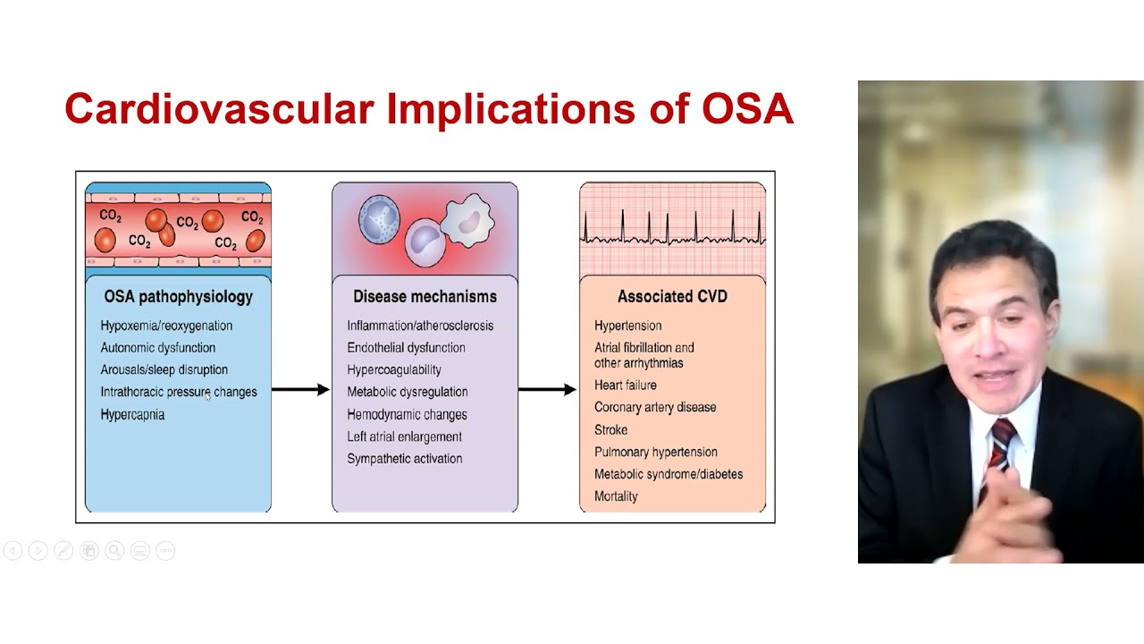 State-of-the-Art Sleep Apnea and Cardiovascular Disease