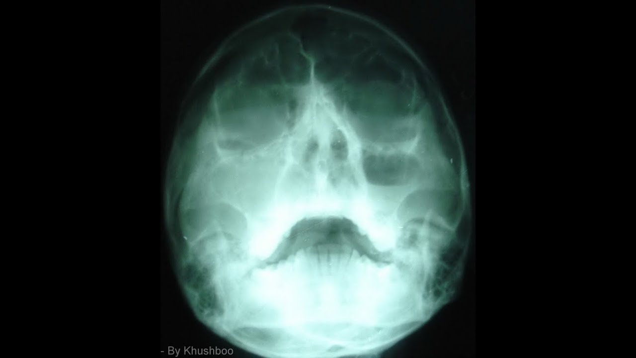 Xray of ENT,Kathmandu Medical College