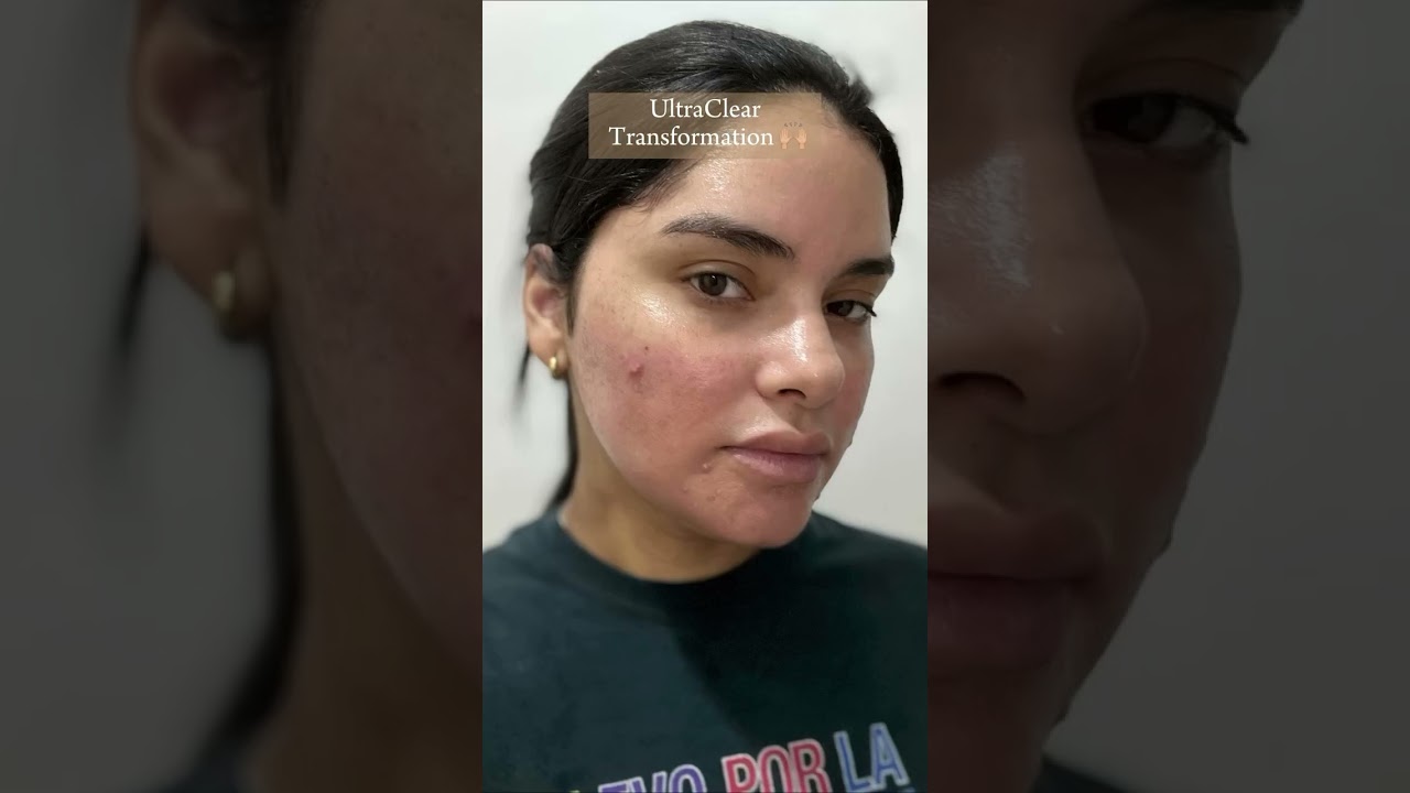 UltraClear Transformation #ultraclear #skincare