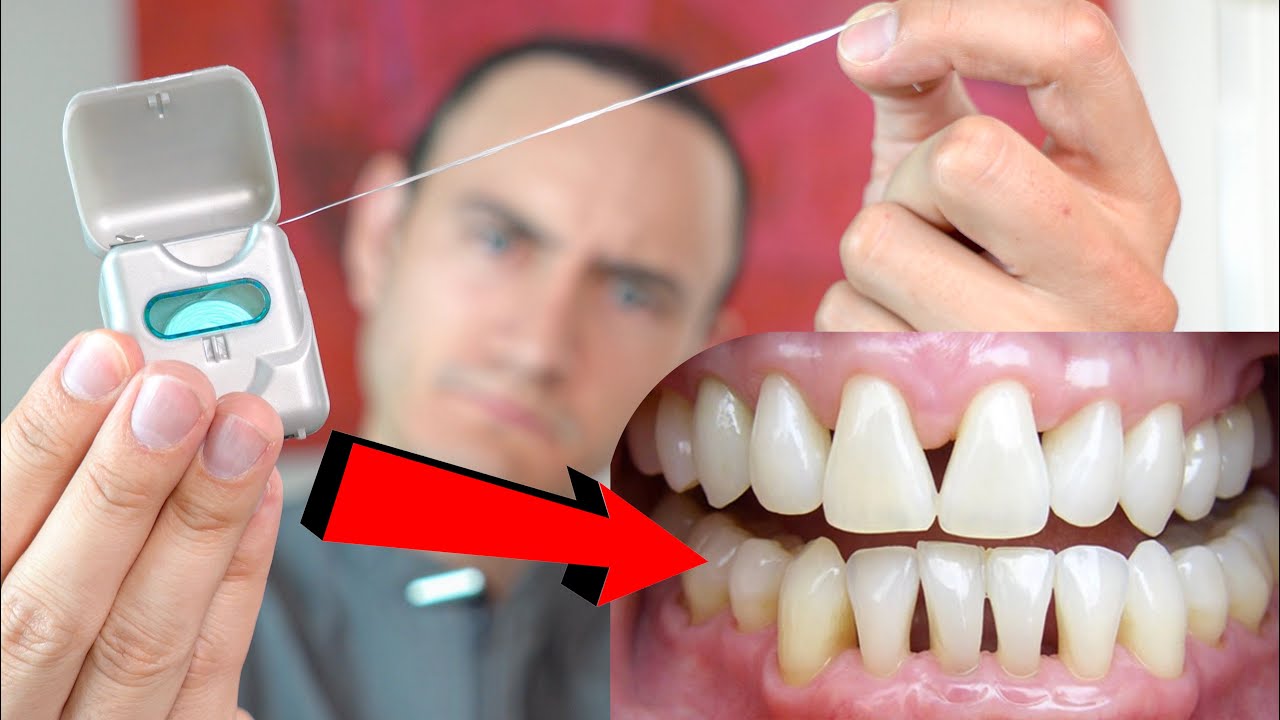 El Hilo Dental puede aflojar tus dientes. &iquest;Qu&eacute; hacer para que eso no suceda?