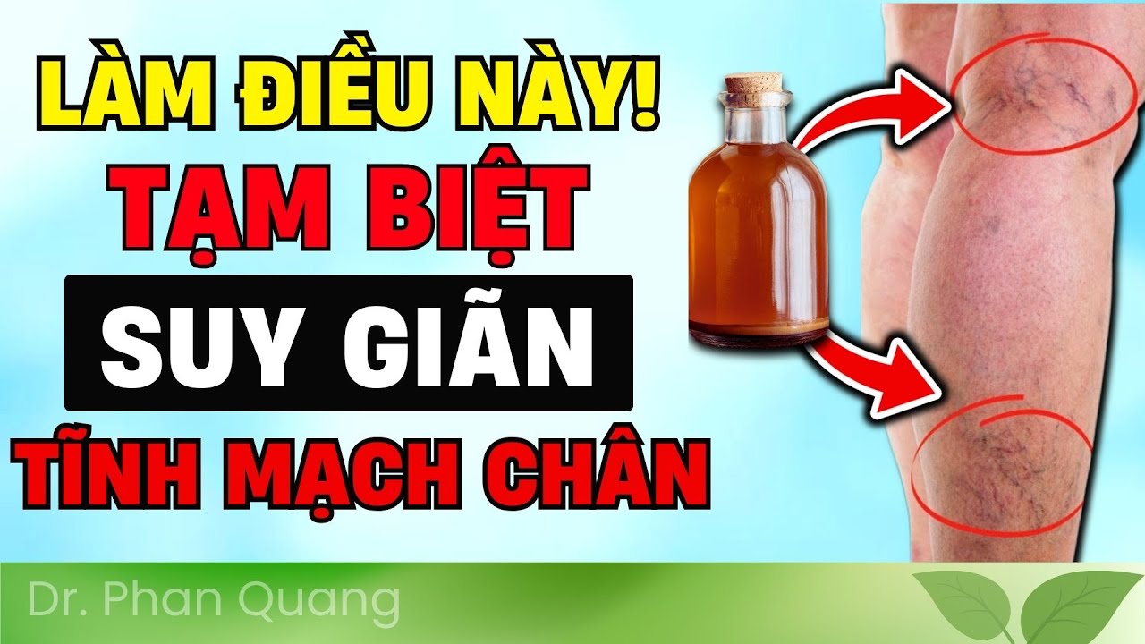🔵 TẠM BIỆT SUY GIÃN TĨNH MẠCH CHÂN! 9 CÁCH TRỊ DỨT ĐIỂM SUY GIÃN TĨNH MẠCH CHÂN TẠI NHÀ #drphanquang