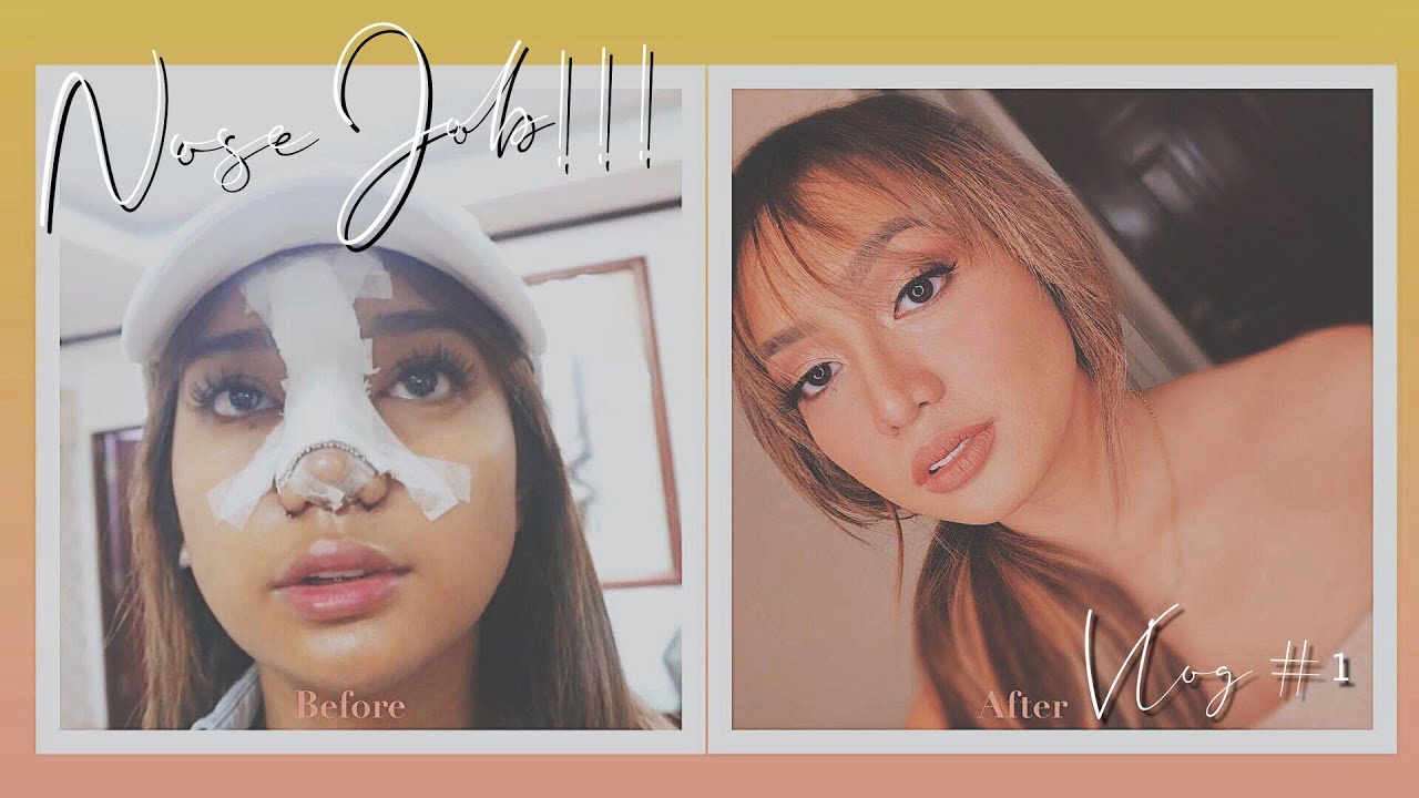 rhinoplasty in cebu!!!  | Anne Cruz