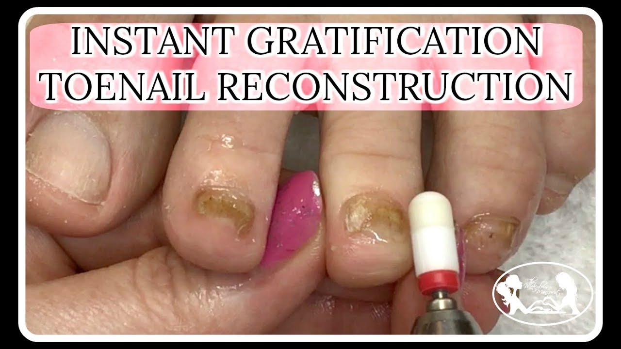 Pedicure Tutorial: Toenail Fungus Reconstruction PediSafe Gel✔️