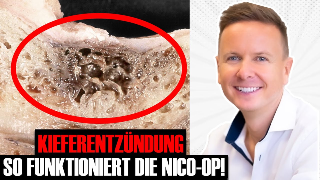 Kieferentzündung- So funktioniert die NICO- OP!
