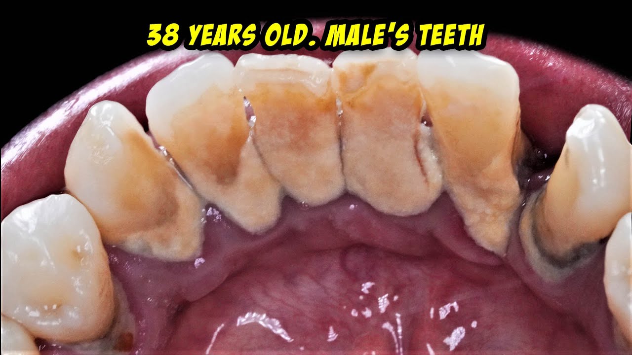 Scaling. | Dentist | Dokter Gigi Tri Putra