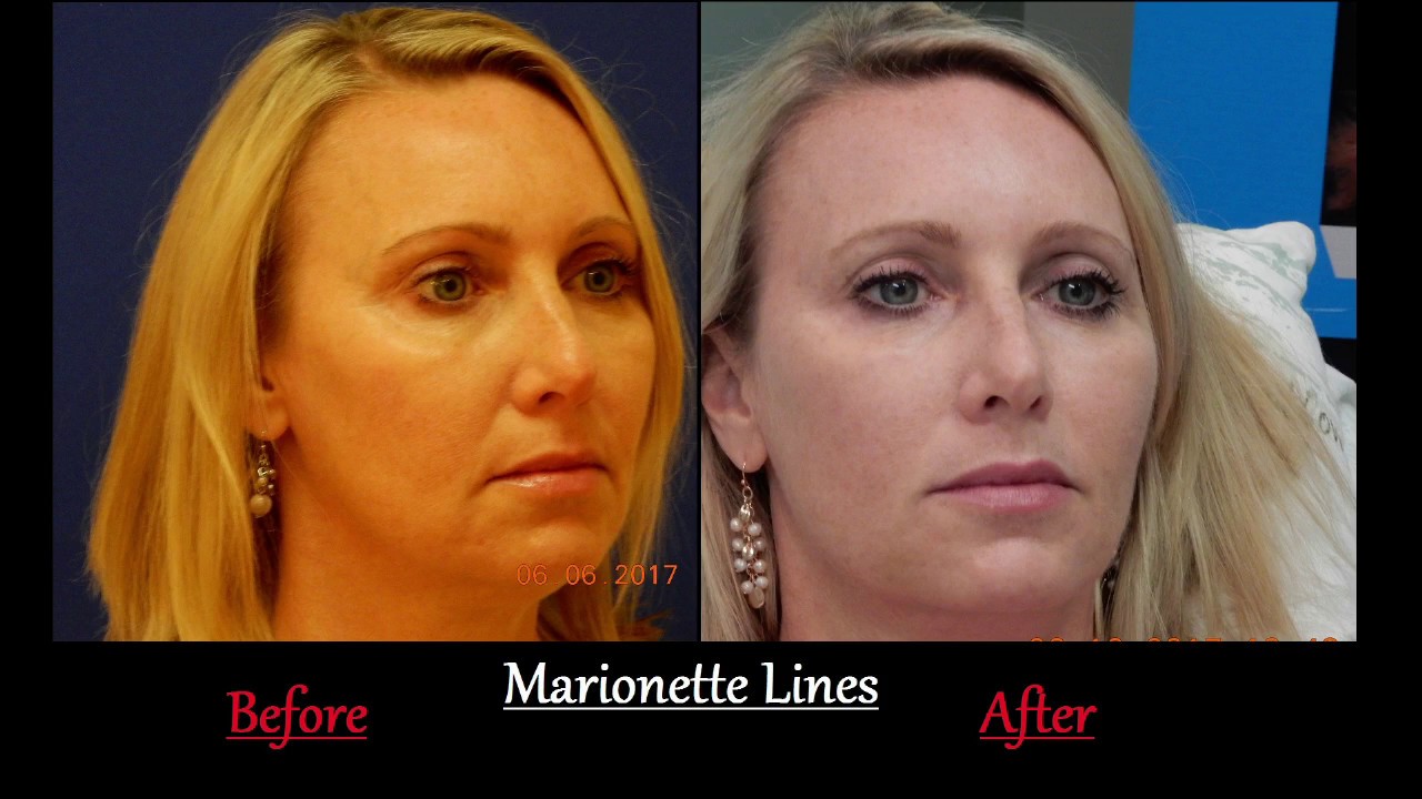 Filler Injection Technique - Marionette Lines - Denville, NJ