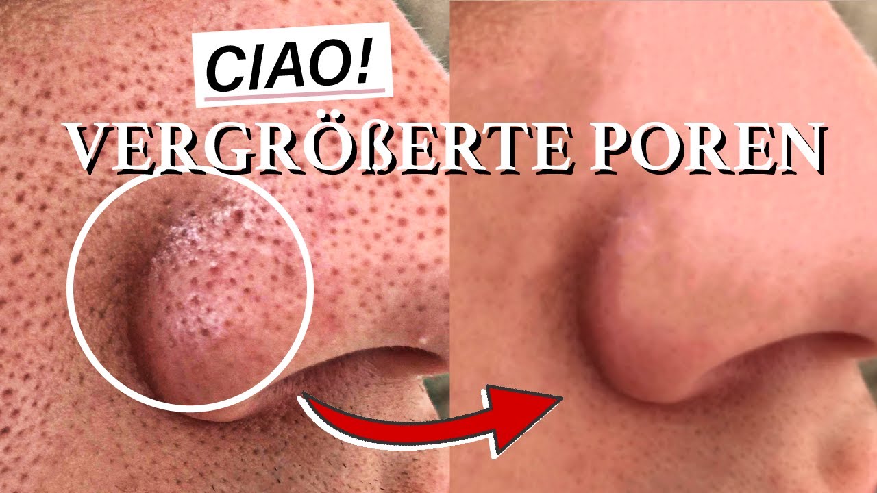 Kein Witz!👃❌ Vergrößerte Poren im Gesicht loswerden (Große auf Nase, Wangen, Stirn entfernen)