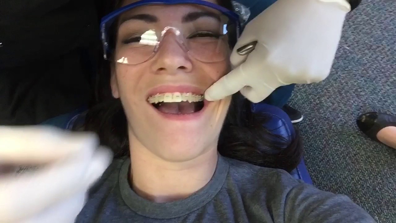 Adult Braces - 6 Month Update and Final Wire