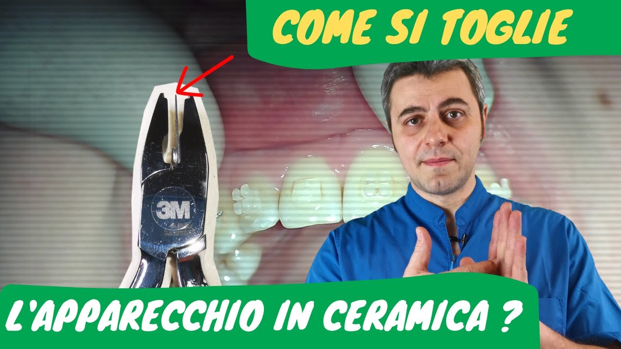 Come si toglie l'apparecchio in ceramica?