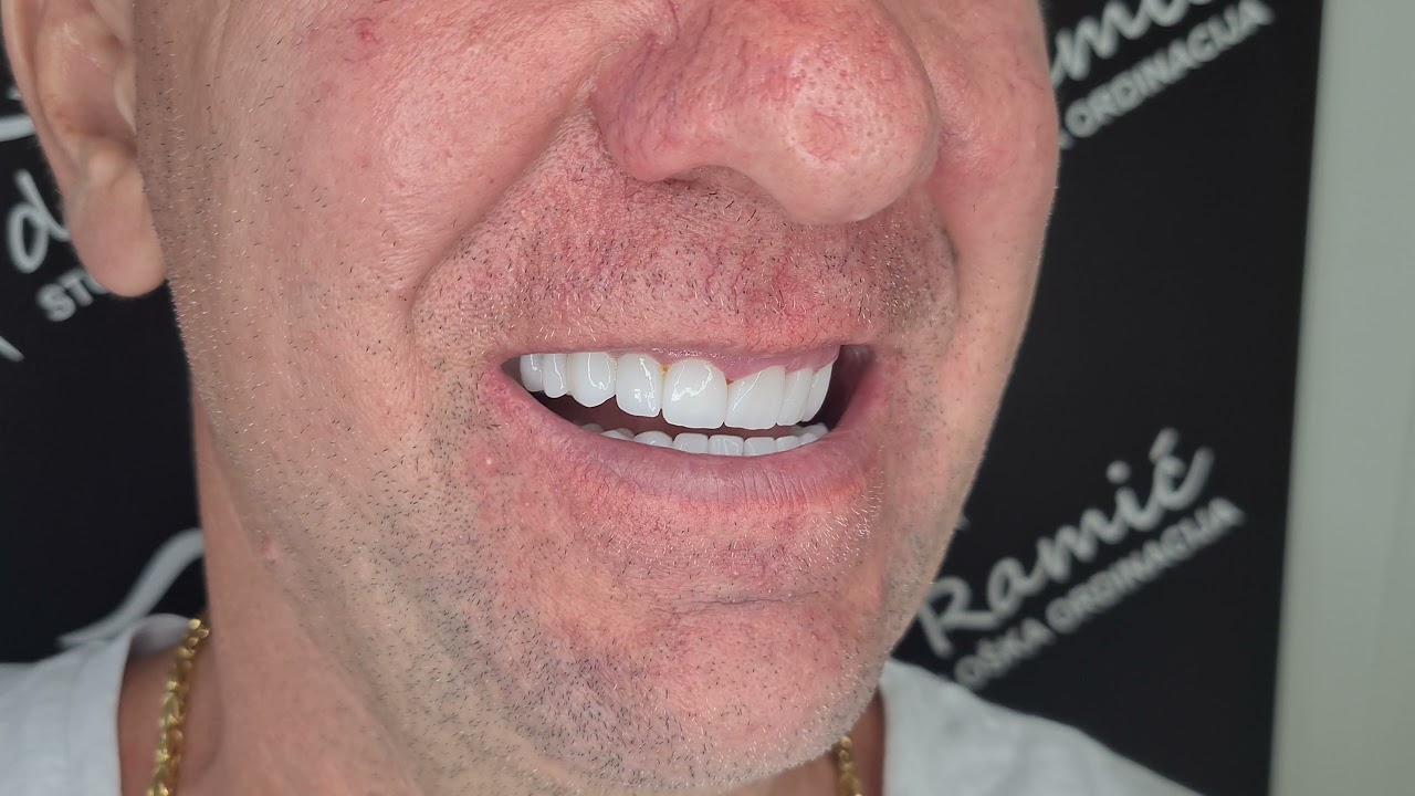 Cirkon - keramički most - Zirconia Dental Bridge