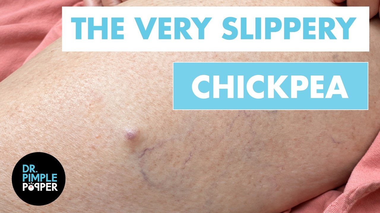 Dr. Pimple Popper против &laquo;скользкого нута&raquo; | Пилярная киста на бедре