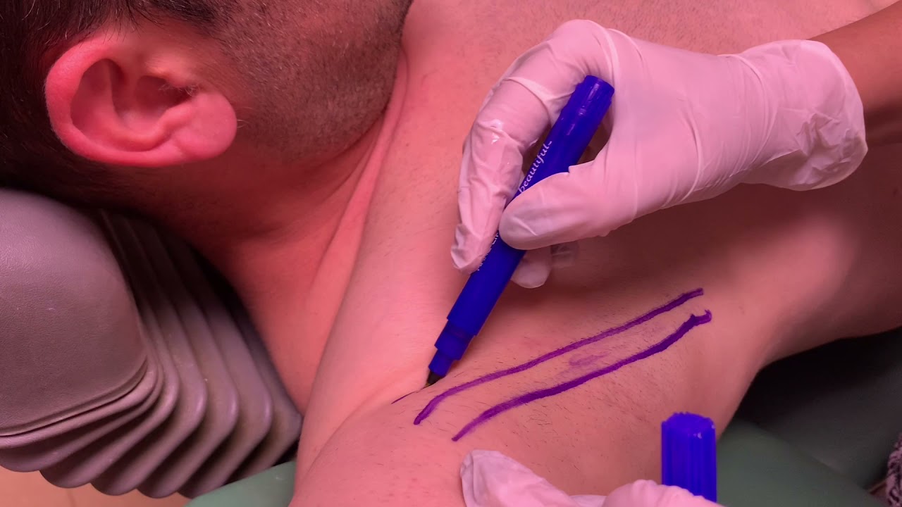 Tratament transpiratie excesiva la barbati |  Injectare Botox in axile | Dr. Ioana Tuhar