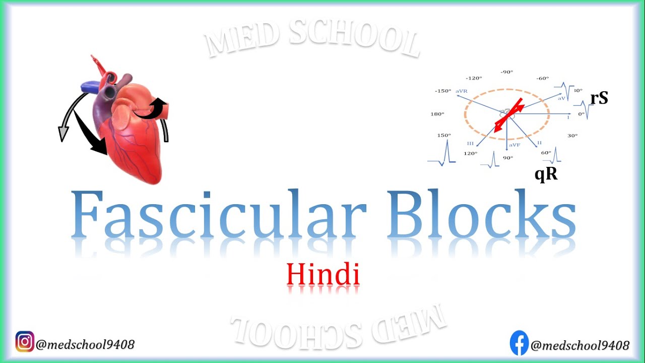 Fascicular Blocks Hindi