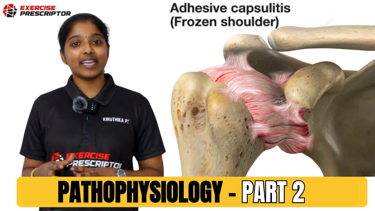 Pathophysiology of frozen shoulder part-2 stiff shoulder
