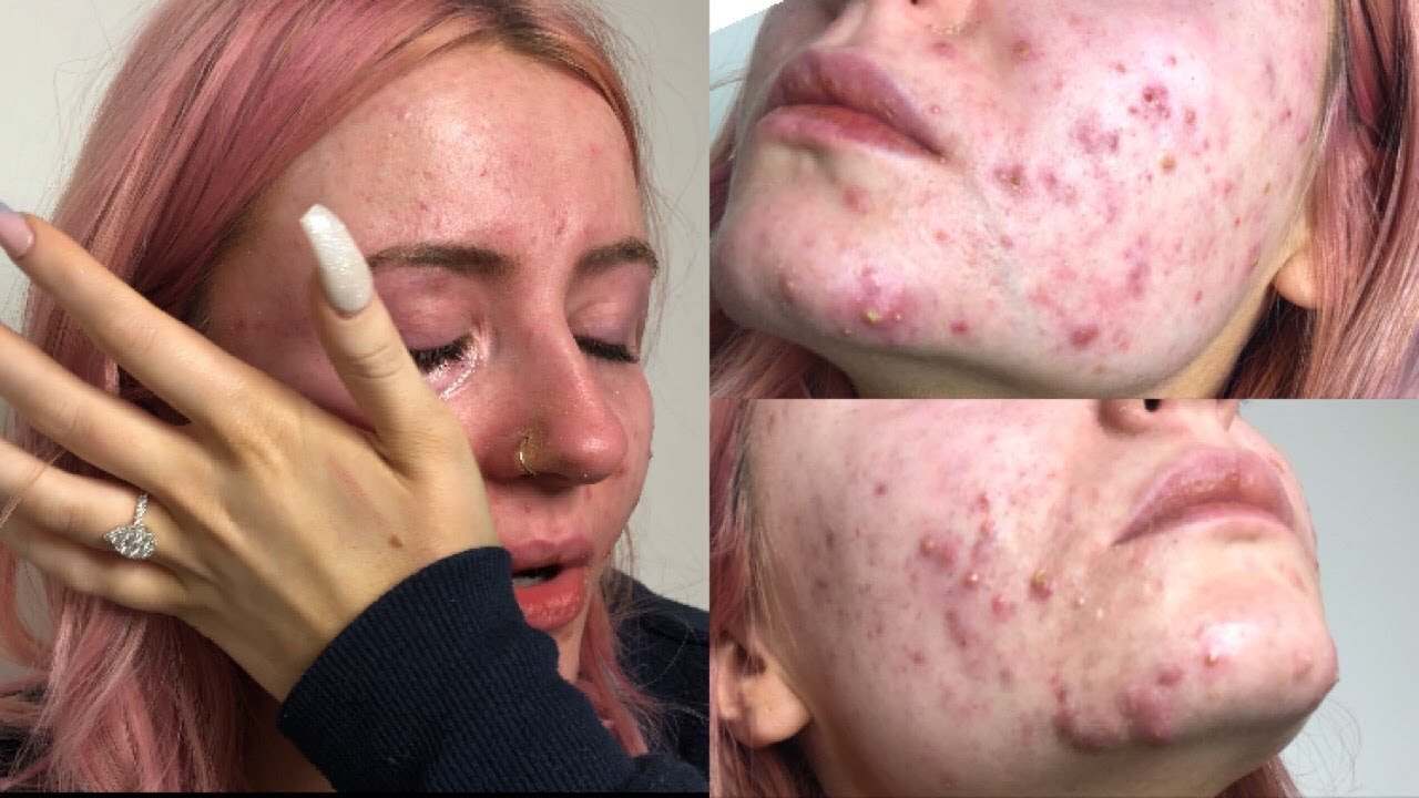 BEING HONEST ABOUT MY ACNE