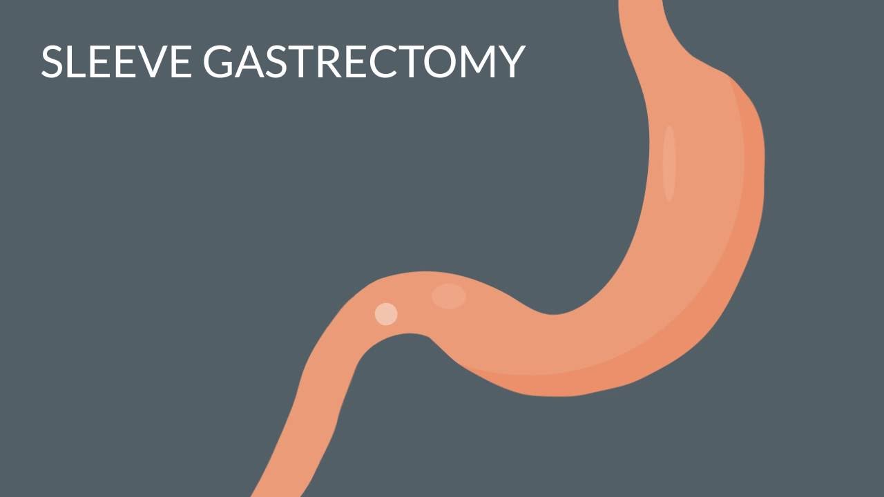 Bariatric Surgery Options | UnityPoint Clinic Weight Loss