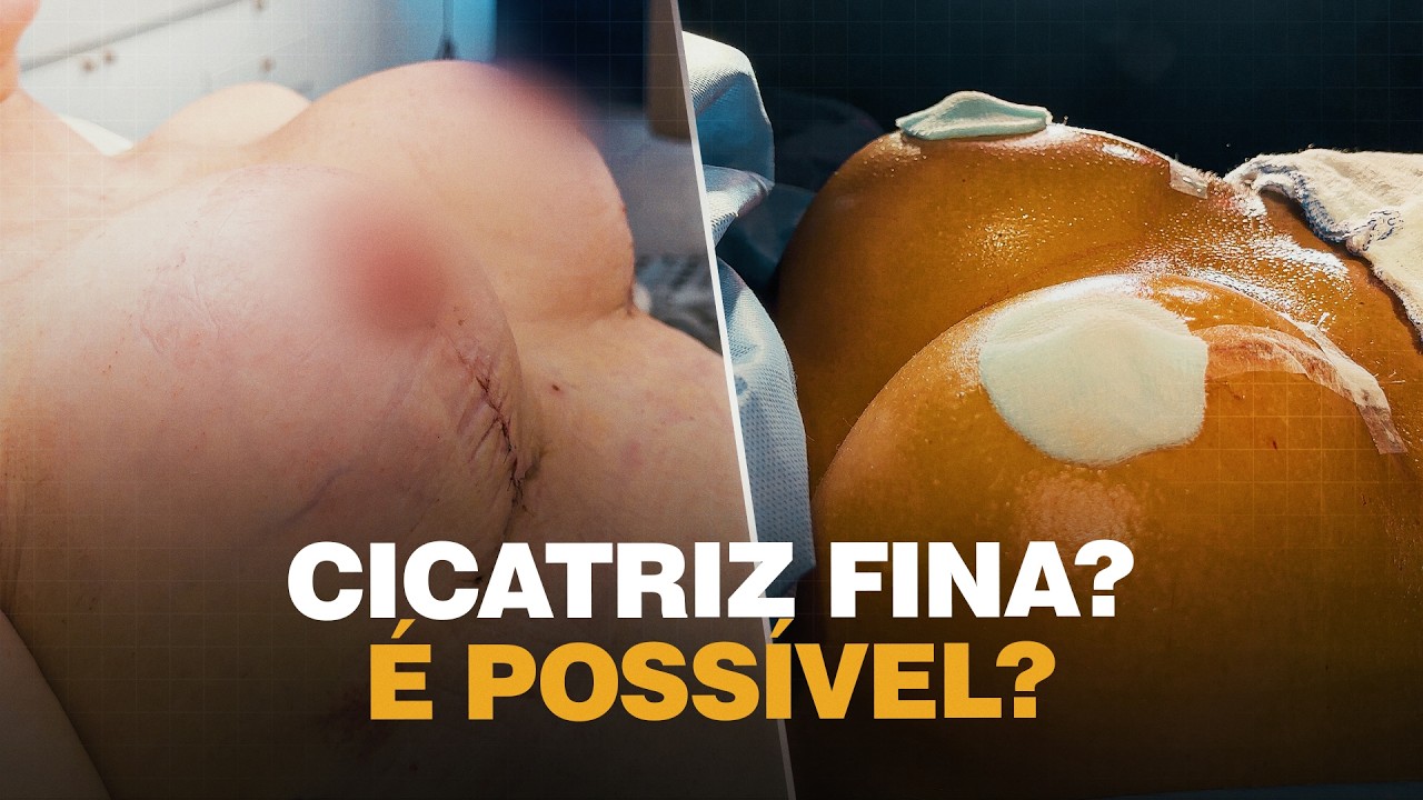 5 Verdades Dolorosas Sobre Cicatriz da Mastopexia Que Você Precisa Saber Antes de Operar | Dr. Ícaro