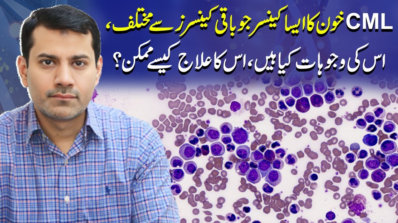 Understanding CML: Causes, Symptoms, and Treatment | Chronic Myeloid Leukemia | Dr Nasir Abbas