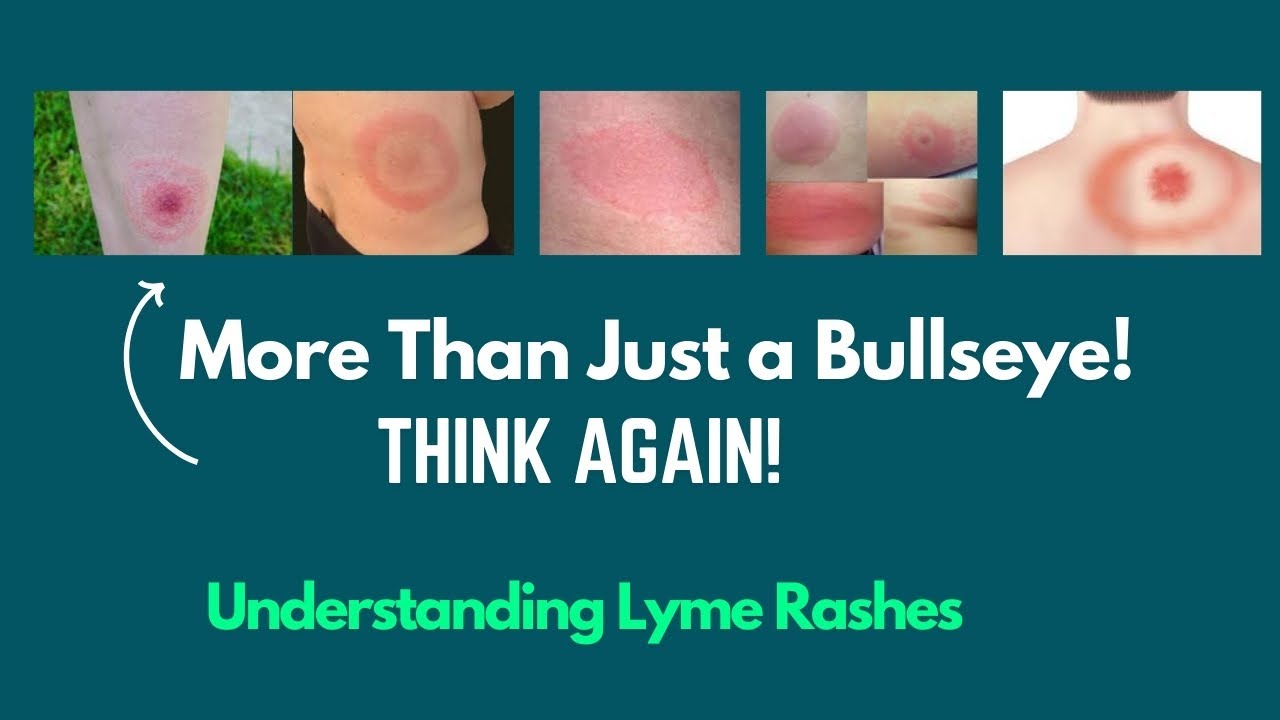 Lyme Disease Rash: What Does It Really Look Like?