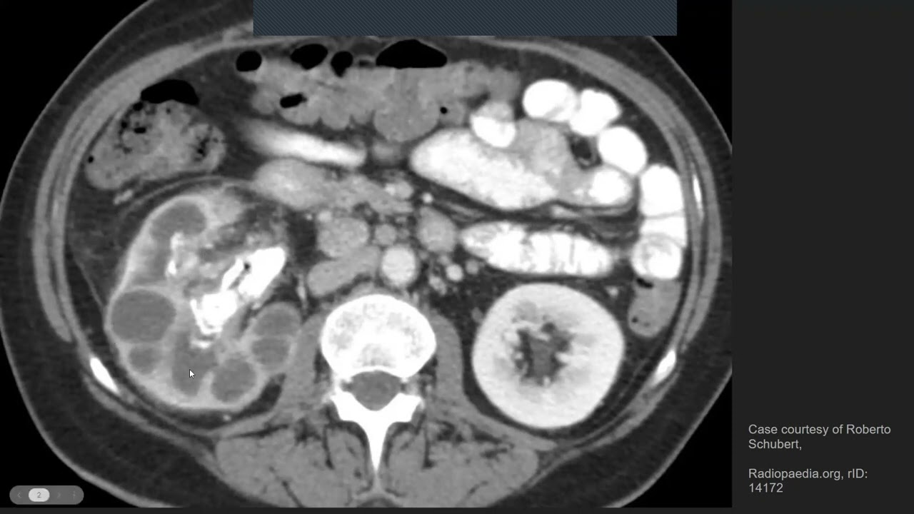 XGP (xanthogranulomatous pyelonephritis)