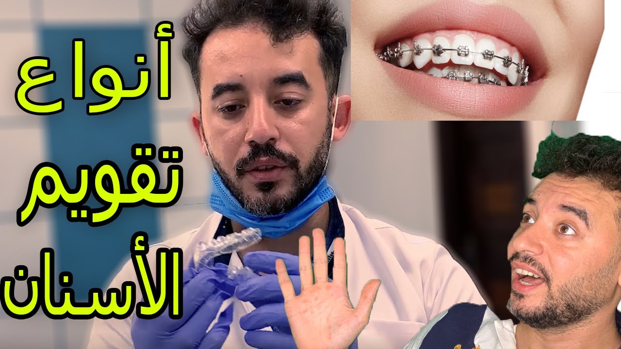 أنواع تقويم الأسنان ✅قصة تقويم الأسنان الشفاف💋 وأسعار التقويم 👀