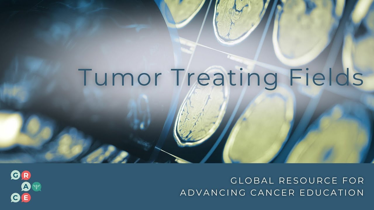 Tumor Treating Fields: An Overview- Mesothelioma and Glioblastoma, 2024