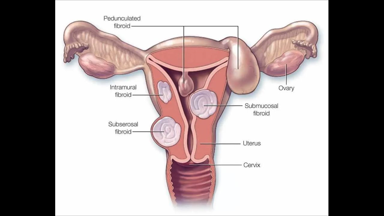 Mayo Clinic Minute - Nonsurgical treatment for uterine fibroids
