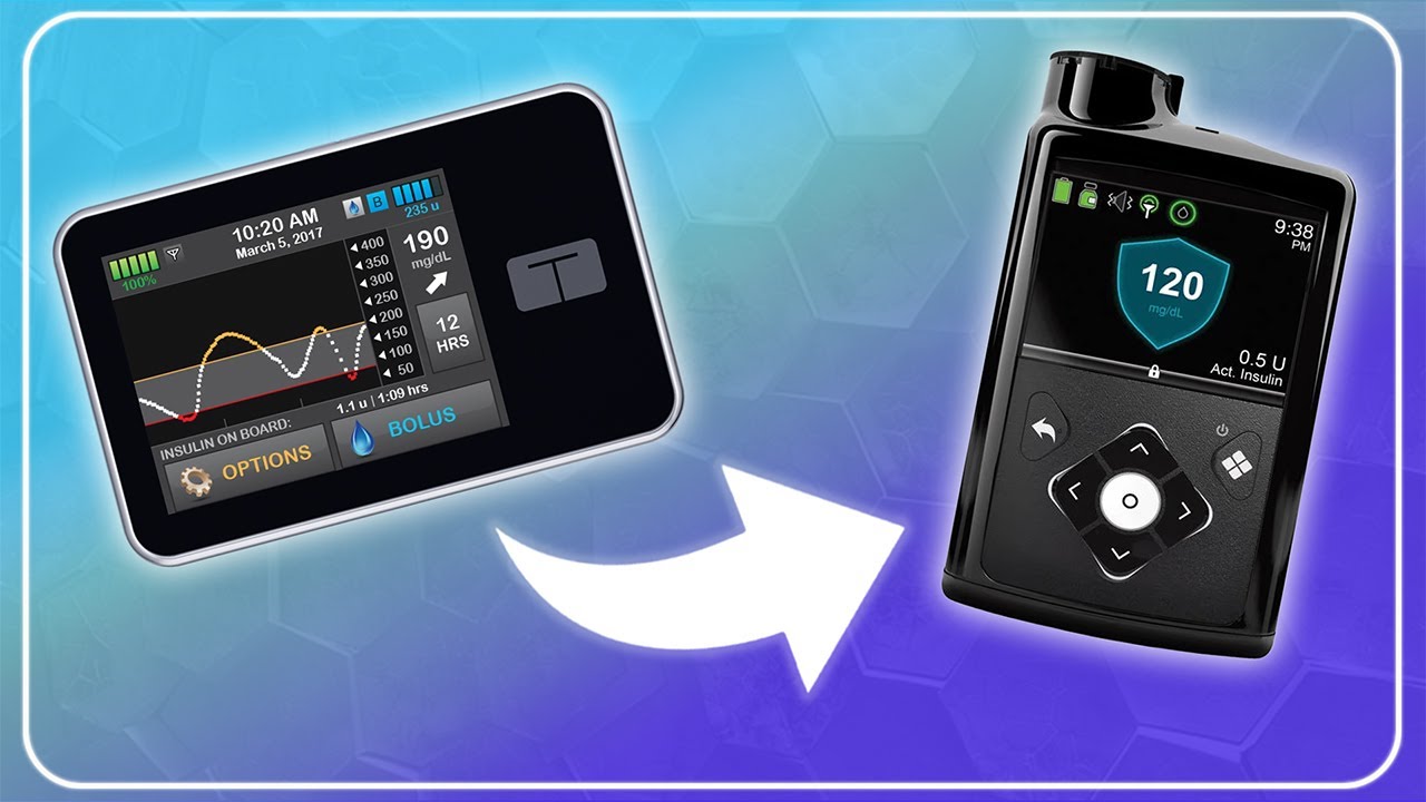 Switching from Tandem t:slim X2 to Medtronic 780g - Pros & Cons