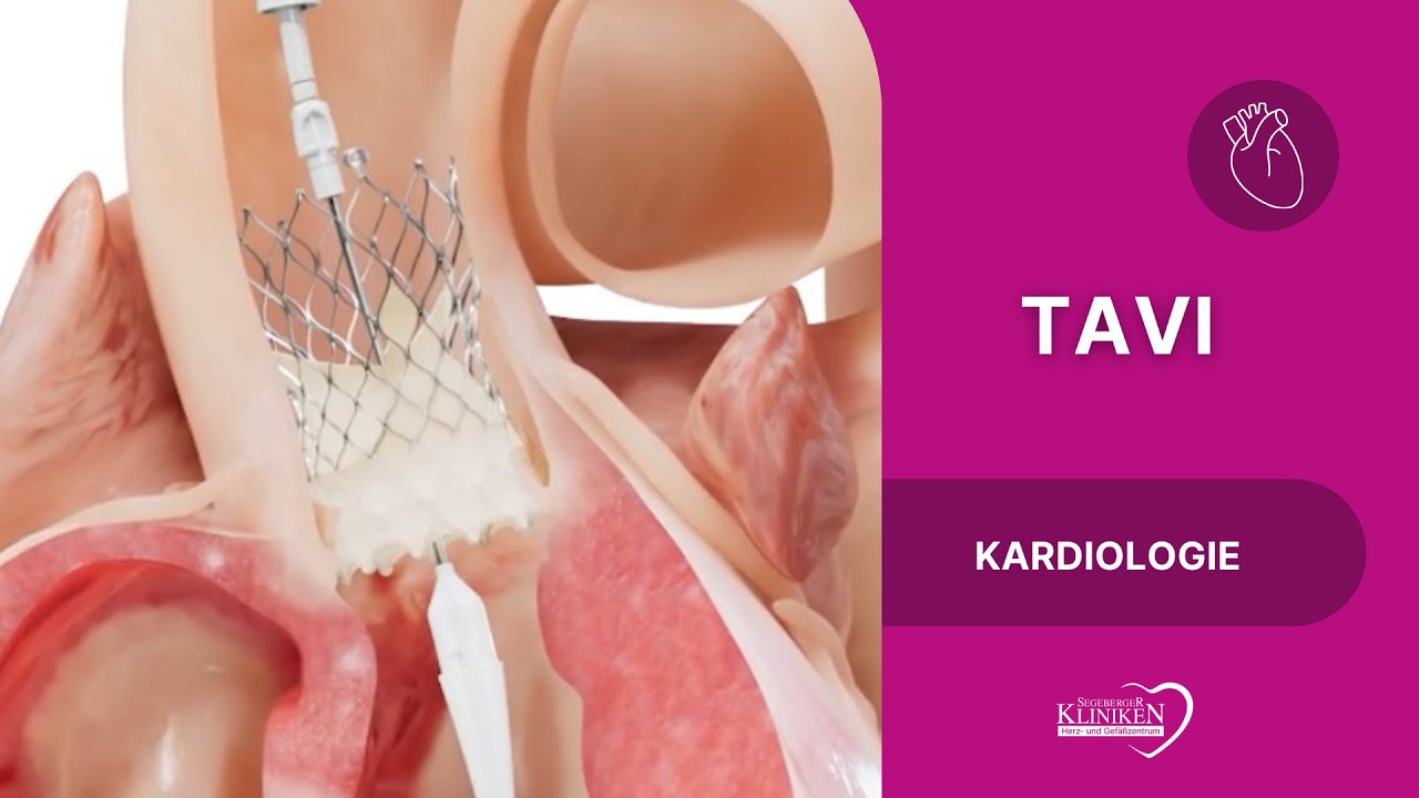 TAVI - Transkatheter-Aortenklappenimplantation