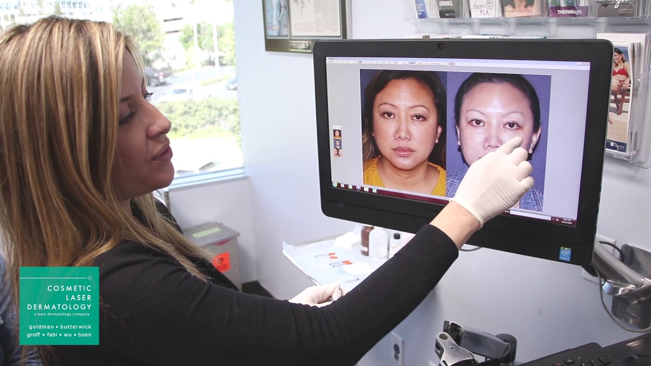 Botox Injections to Enhance Female Cheek Prominence | Demonstrated by Dr. Sabrina Fabi