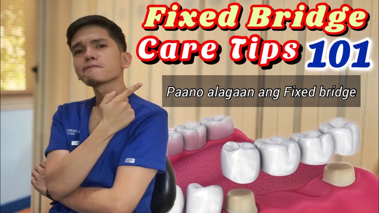 FIXED BRIDGE CARE 101: Mabaho? May sira? Maintenance? Paano alagaan?
