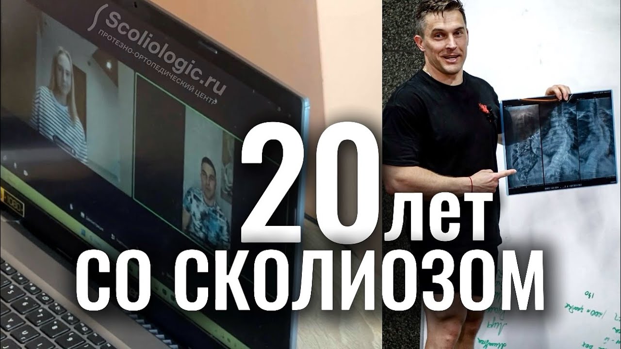 20 лет со сколиозом: не прятаться, а жить!