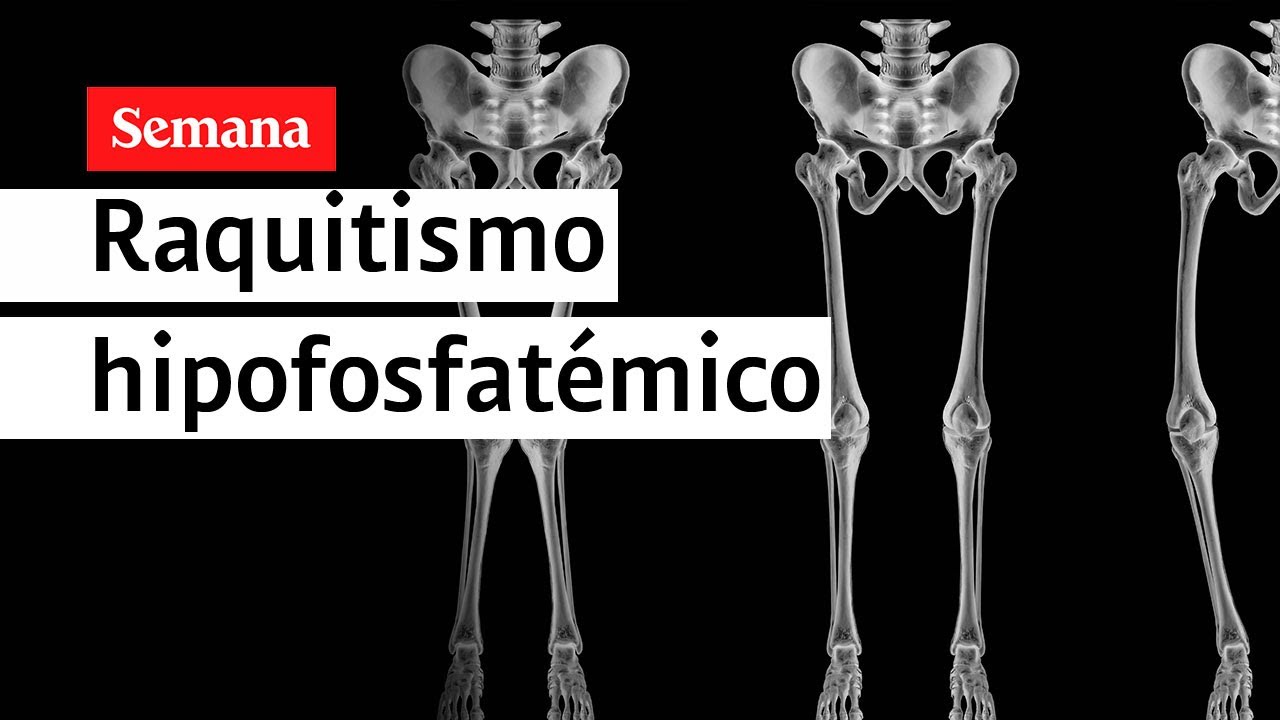 Testimonio de vida de una paciente con raquitismo hipofosfatémico