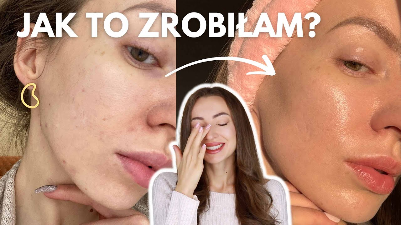 💖TOP zmiany w PIELĘGNACJI, które ODMIENIŁY moją trądzikową skórę💖