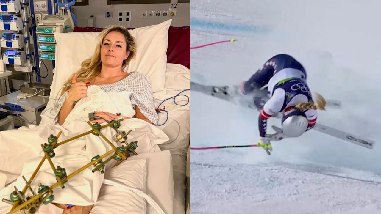 Lindsey Vonn Gives Video Update After Breaking Leg At Olympics