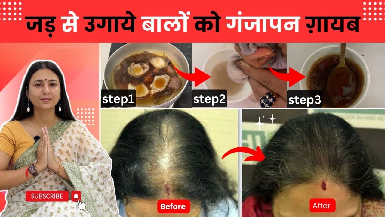 खोये हुए बालों को दोबारा उगायें, गंजापन दूर करें | Lost Hair Growth Challenge | Hair Growth Serum