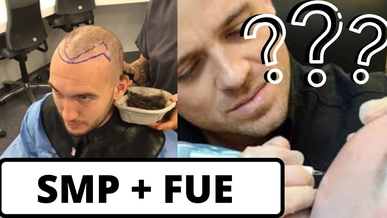 Can You Combine SMP and FUE/FUT