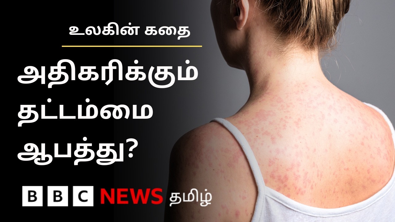 கட்டுக்குள் வந்துவிட்டதாக நினைத்த தட்டம்மை மீண்டும் அதிகரிப்பது ஏன்? Ulagin Kathai