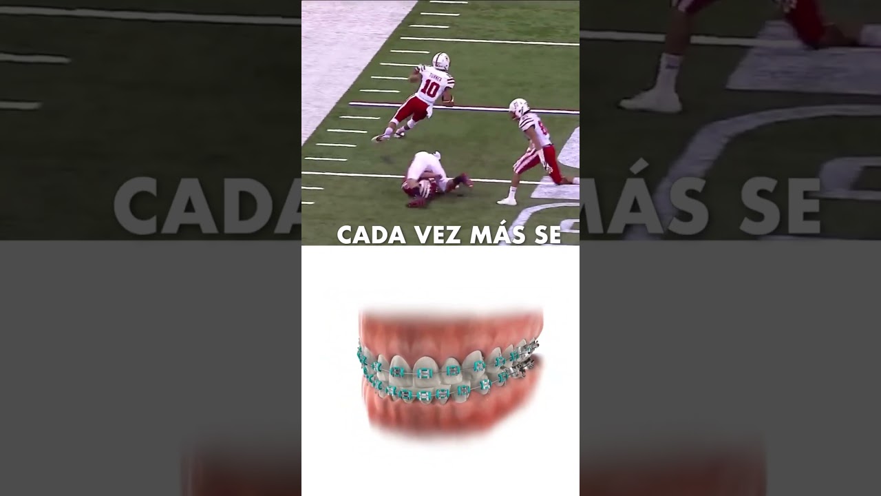 &iquest;BRACKETS Y DEPORTES? 🚨