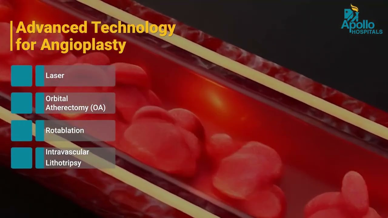 Angioplasty vs Bypass Surgery | Which Is Right for You?